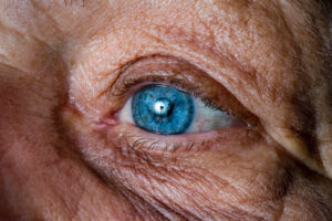 Cataracts: Senior Home Care Tanglewood TX