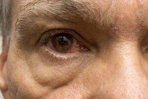 Eye Infections: Elder Care Tanglewood TX